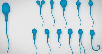 Тератзооспермия